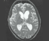 Диффузное аксональное повреждение головного мозга: причины, симптомы, лечение, последствия, прогноз