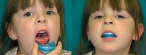Детские и взрослые трейнеры для зубов: разновидности, показания, правила ношения, стоимость
