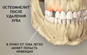 Остеомиелит нижней и верхней челюсти: симптомы, лечение хронического и травматического остеомиелита после удаления зуба