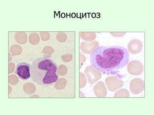 Моноциты в крови (повышены, понижены) – нормы у ребенка и взрослого