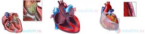 Кардит (воспаление оболочек сердца): причины, формы, симптоматика, диагностика, лечение