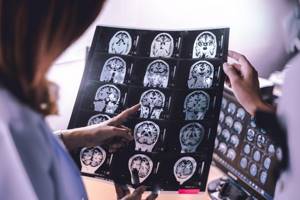 Атрофия мозга (церебральная): причины, симптомы и стадии изменений, лечение и последствия