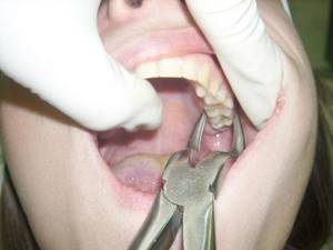 Удаление корня разрушенного и гнилого зуба: больно ли удалять, как удаляют если остался только корень
