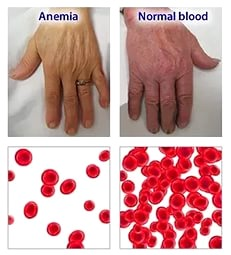 Гемолитическая анемия: что это такое, симптомы, лечение, причины