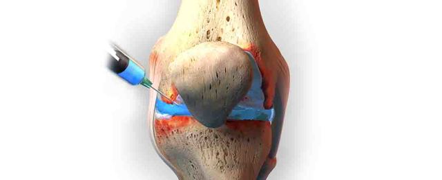 Синовиальная жидкость: что это, состав и функции восстановления