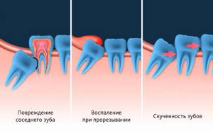 Зубы мудрости: где находятся и как выглядят после удаления, строение, как растут, сколько корней