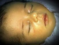 Билирубин у новорожденных: норма, повышен, причины и последствия