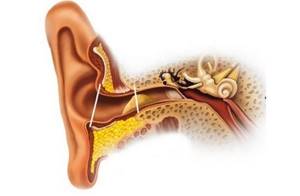Ушная пробка: симптомы у взрослого и ребенка, как выглядит, лечение и признаки серной у детей