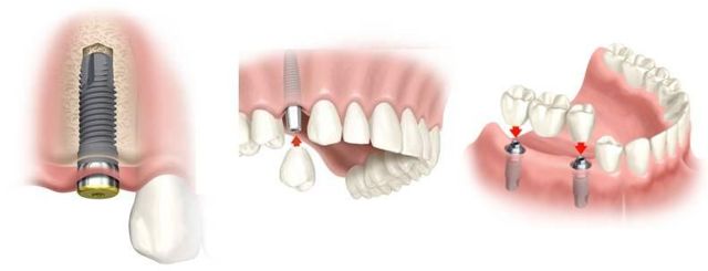 Штифт в зубе: что такое штифтовые зубы, как ставят при зубном протезировании, виды, сколько стоят