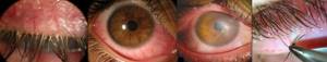 Демодекоз на глазах: лучшие препараты для лечения