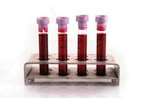 ПСА анализ крови и его расшифровка: что означает онкомаркер, что это такое