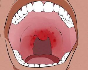 Жжение во рту и на языке: причины какой болезни, лечение. Почему печет губы, горло, небо, десны