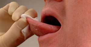 Кровоточит язык: причины, как остановить, почему, что делать