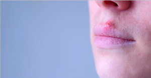 Почему на губах появляются белые пятна, как лечить