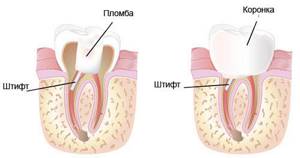 Штифт в зубе: что такое штифтовые зубы, как ставят при зубном протезировании, виды, сколько стоят