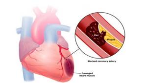 Обширный инфаркт: понятие, развитие, признаки, лечение, прогноз и последствия