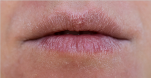 Хейлит на губах: причины заболевания, симптомы, лечение в домашних условиях, мази, фото