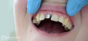 Культевая вкладка для зубов под коронку при протезировании: что это такое, виды, сколько стоит, установка