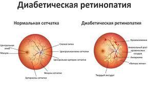 Диабетическая ретинопатия при сахарном диабете: симптомы и лечение
