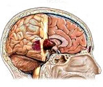 Опухоль головного мозга: обзор видов, симптомы и локализации, выявление, лечение