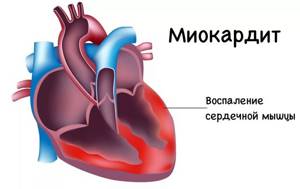 Кардит (воспаление оболочек сердца): причины, формы, симптоматика, диагностика, лечение