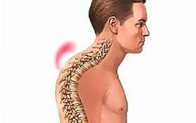 Мышечная невралгия — когда болью сводит мышцы спины, груди и все остальные