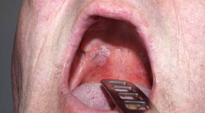 Лейкоплакия слизистой оболочки полости рта и языка: формы лейкоплакии, причины, симптомы, лечение