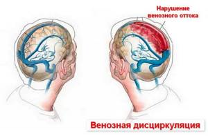Венозная дисциркуляция головного мозга: что это такое, симптомы дисфункции лечение и последствия