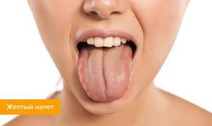 Белый налет на языке у взрослых: причины и лечение