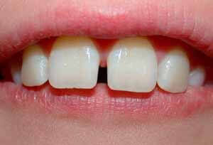 Щель между передними и другими зубами: как исправить и убрать дырку