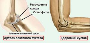 Анкилоз суставов: тазобедренный, коленный, локтевой. Что это такое и способы лечения