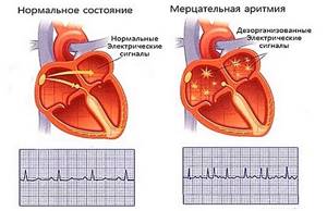 Перебои в работе сердца: причины, когда и как лечить, последствия и прогноз