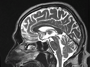 Турецкое седло: строение, функции, диагностика патологий важного отдела мозга