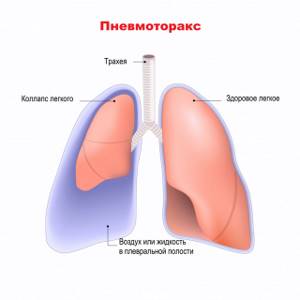 Диссеминированный туберкулёз лёгких заразен или нет