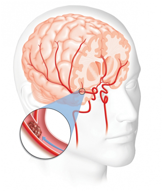 Острое нарушение мозгового кровообращения (ОНМК): что это такое, симптомы, лечение, последствия и прогноз