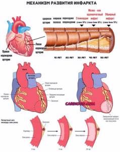 Инфаркт миокарда: причины, как развивается, симптомы и проявления, помощь, терапия, реабилитация