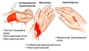 Кровотечения: симптомы и классификация, оказание доврачебной помощи, лечение