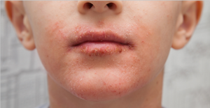Болезни губ у взрослых и детей: названия с фото, причины, симптомы и лечение