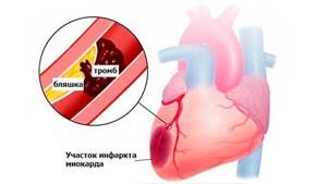 Инфаркт миокарда: причины, как развивается, симптомы и проявления, помощь, терапия, реабилитация
