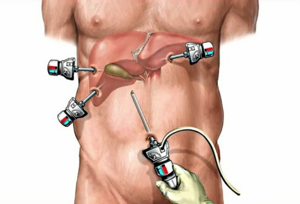 Операция лапароскопия желчного пузыря - подготовка, проведение, последствия