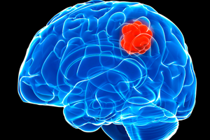 Олигодендроцитома головного мозга анапластическая и высокодифференцированная: лечение, сколько живут