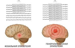 Что это такое эписиндром и как проявляется симптоматическая эпилепсия: симптомы и лечение