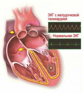Фракция выброса левого желудочка сердца: нормы, причины понижения и высокой, как повысить