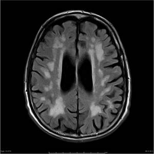 Что это такое лейкоареоз головного мозга: симптомы, лечение, профилактика
