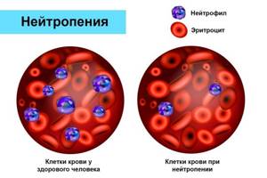 Нейтрофилы в крови: нормы по возрастам (таблица), причины повышения и снижения клеток