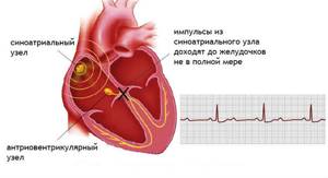 Нарушение проводимости сердца: понятие, виды (внутрипредсердной, внутрижелудочковой), проявления, принципы терапии
