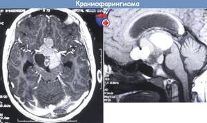 Краниофарингиома головного мозга: удаление, последствия и выживаемость