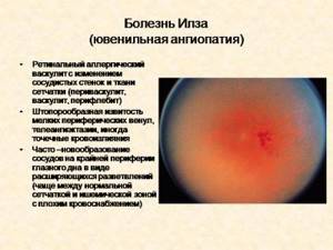 Ангиопатия сетчатки глаза: у ребенка, новорожденных детей, грудничка, что это такое