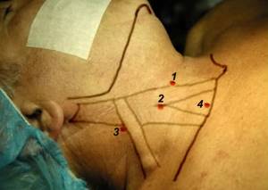 Расширение яремной вены на шее: причины, правой внутренней (справа), последствия, левой, лечение