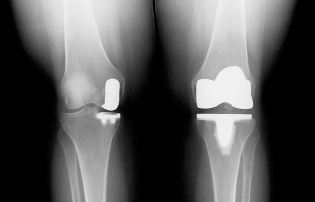 Выбираем эндопротез коленного сустава: срок службы, материалы, цены